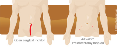 prostatectomy_comparison395x159
